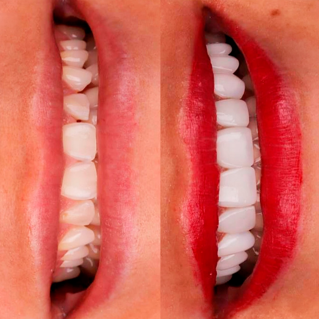 Registro clínico de antes e depois de tratamento odontológico